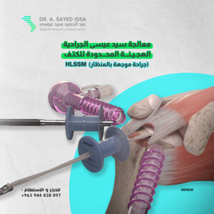 الجراحة الهجينة المحدودة للكتف 1 Hybrid Limited Shoulder Surgery